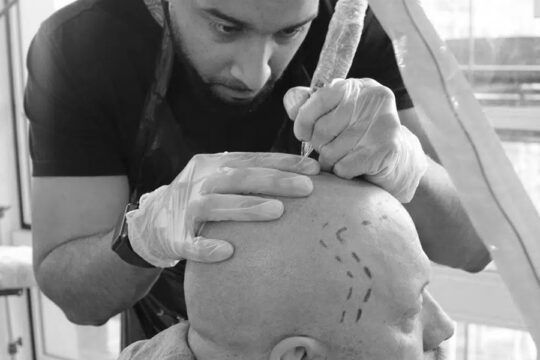 How much does a Scalp Tattoo Cost?