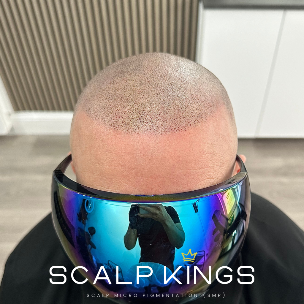 After results of scalp micrpo pigmentation with scalp kings smp clinic bristol
