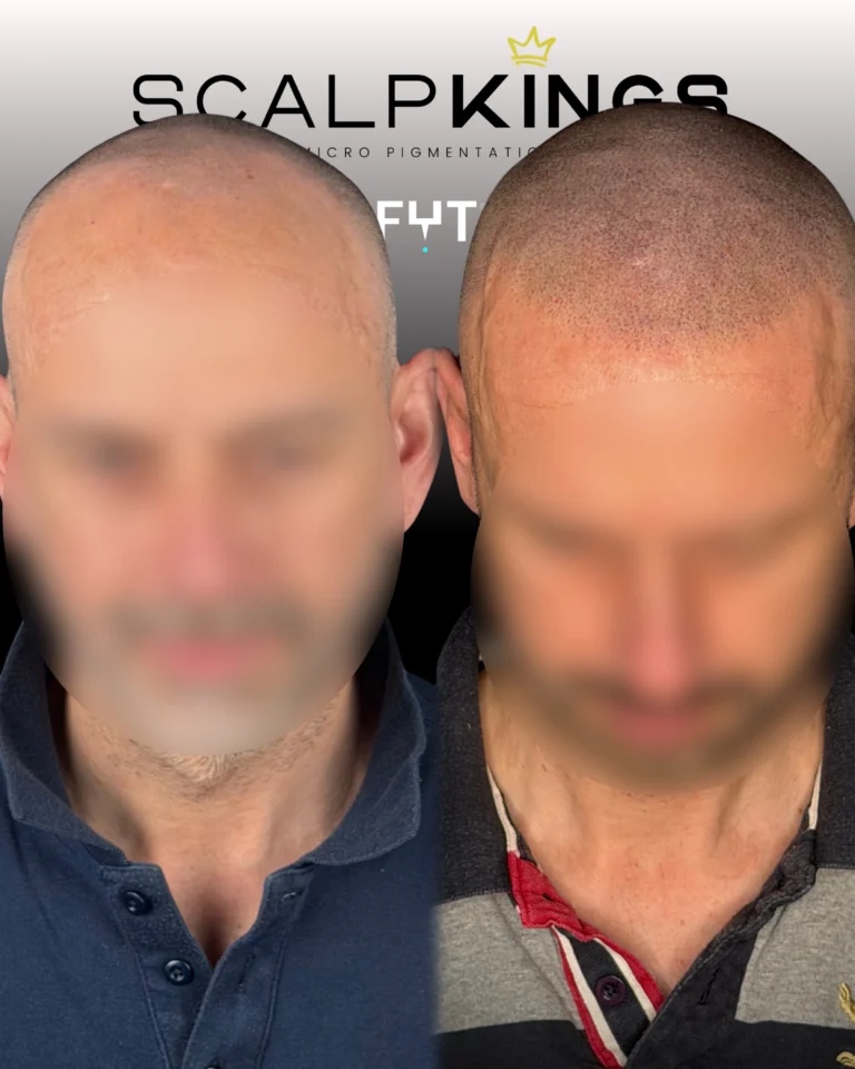 Instagram post from scalpkings. This post is in position 1.