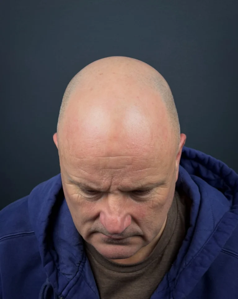 Instagram post from scalpkings. This post is in position 1.