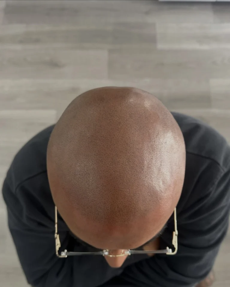 Instagram post from scalpkings. This post is in position 1.