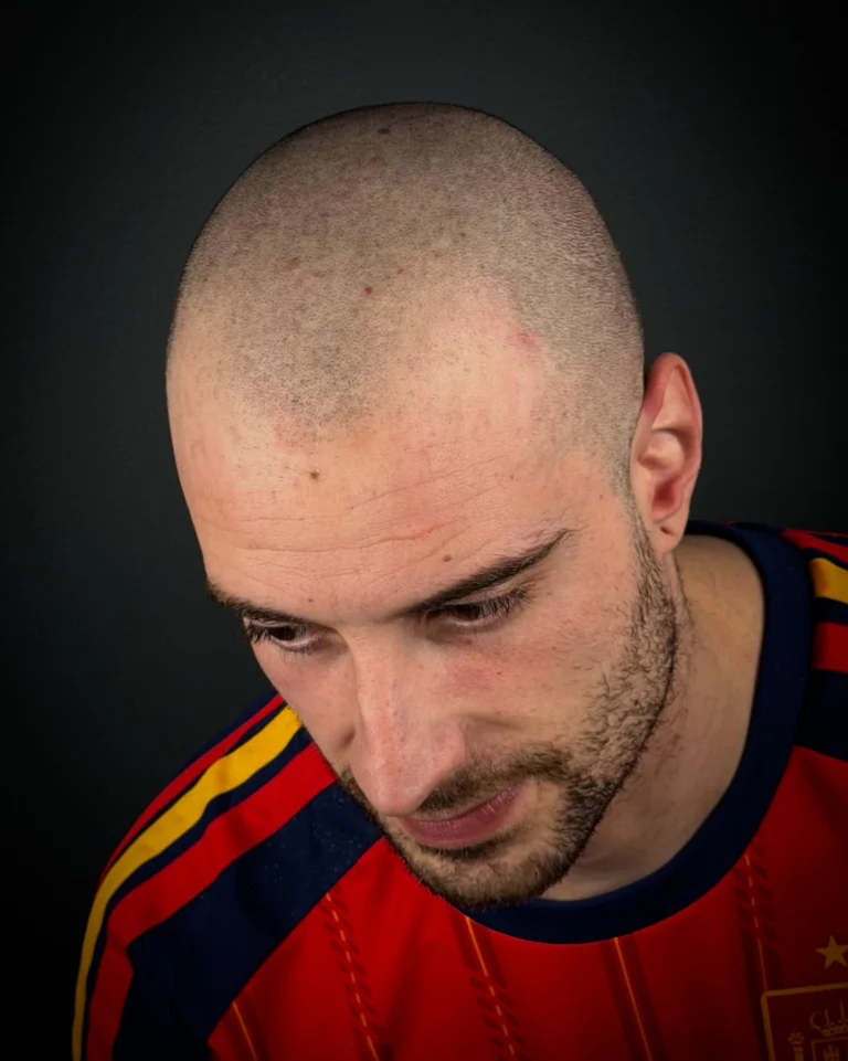 Instagram post from scalpkings. This post is in position 1.